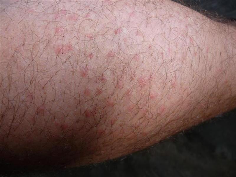 Mosquito bites on my leg