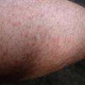 Mosquito bites on my leg