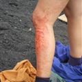 The girls leg who went 69 km down the volcano